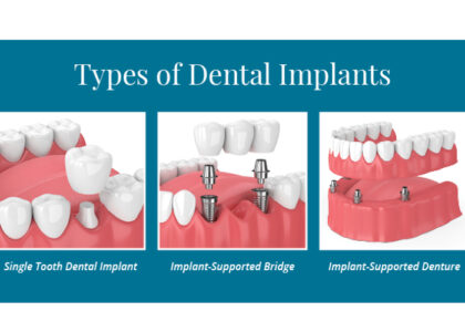 implants in dwarka