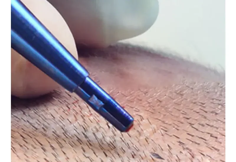 Hair Transplant in Istanbul